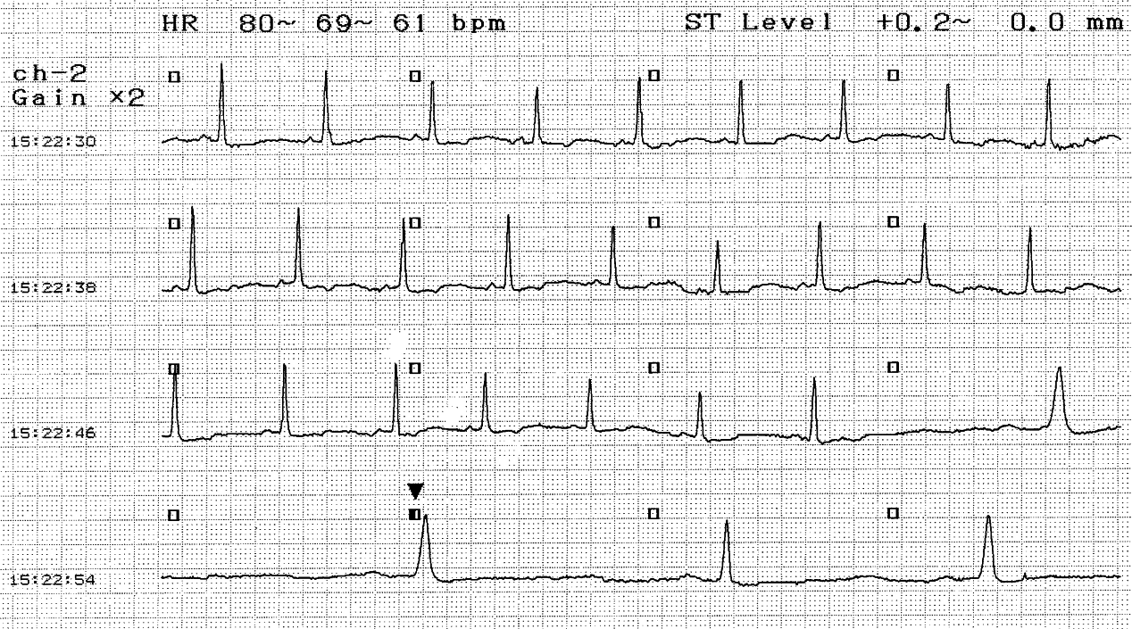 82 year old lady scheduled for a permanent pacemaker after this Holter study was interpreted by a Cardiologist