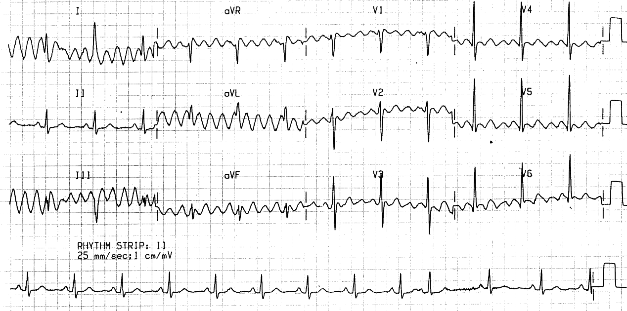 81 year old with no known heart disease.