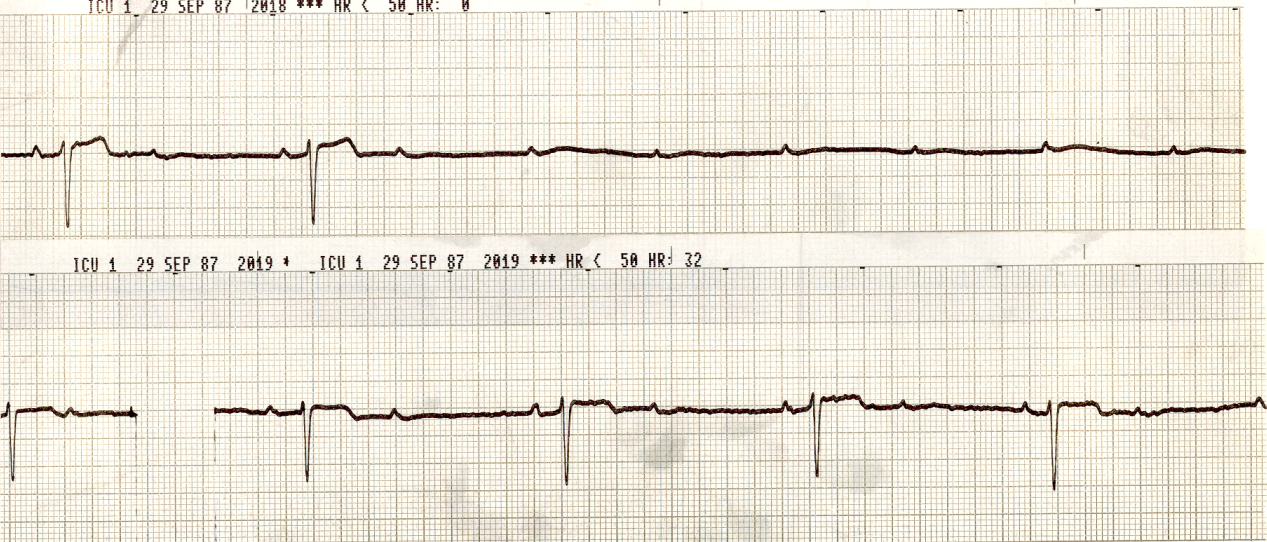 In the top strip extra P waves lurk from the first and the last QRS most obviously. The in-between could pass for a Wenckebach sequence, exceptâ¦ 