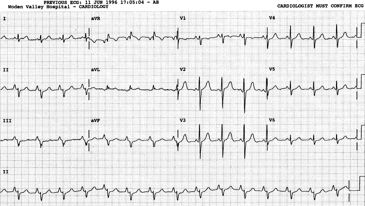 48 year old lady admitted for cholecystectomy.