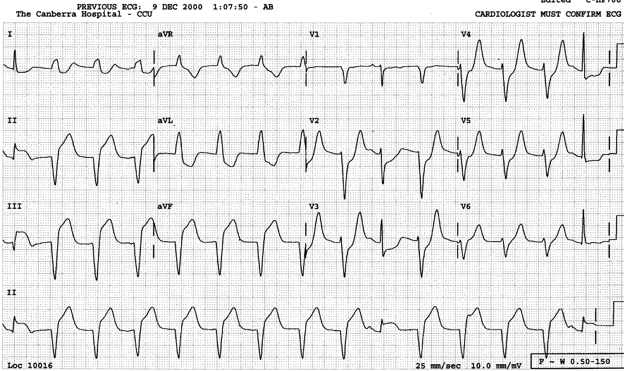 66 year old lady with chest pain.