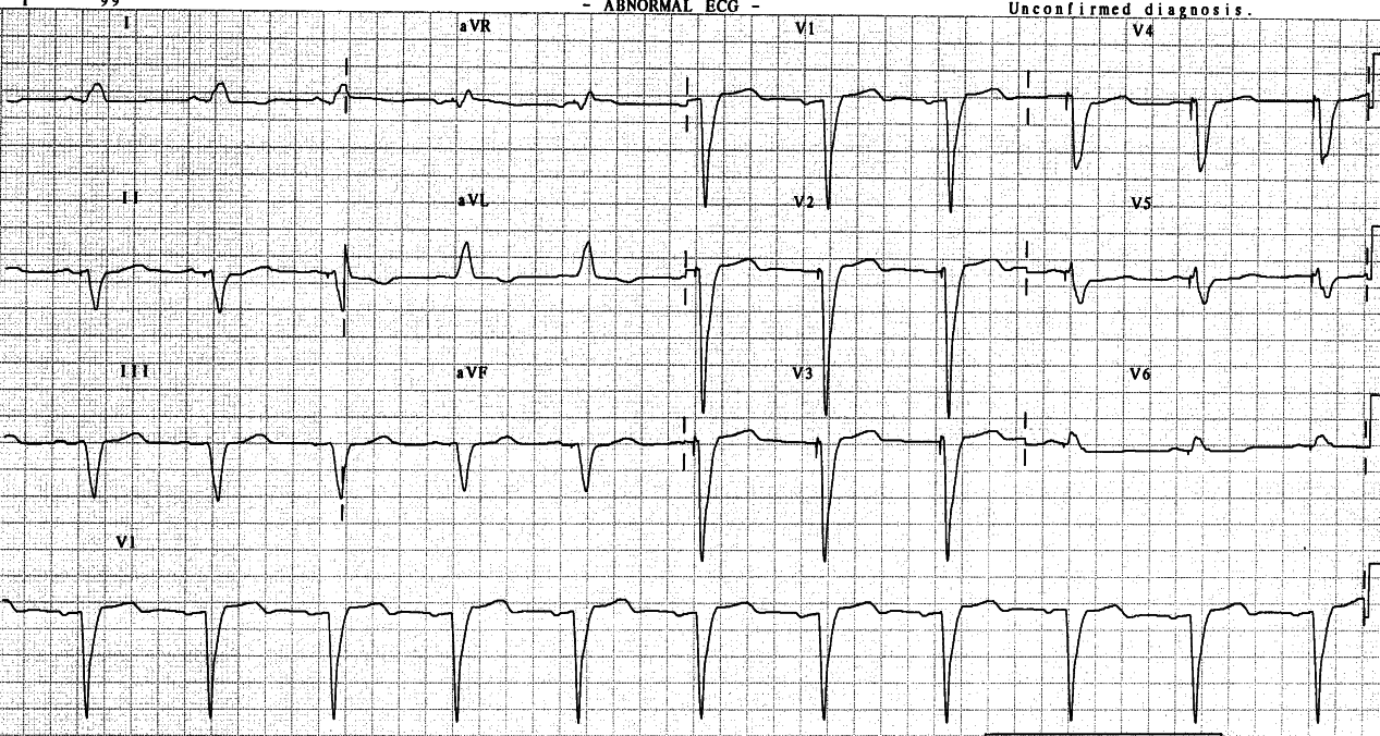 78 year old man with implanted cardioverter-defibrillator (ICD)
following aortic valve replacement several years ago.