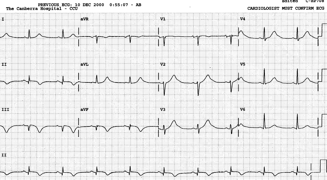 The somwhat splayed T waves may be at least in part be due to anti-arrhythmic treatment, for unknown indication. Surely not AIVR?