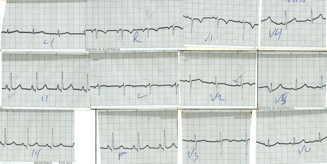 46 year old lady with COAD and atypical chest pains. The consultant reported: âNo changes. Old inferior MI. Exclude PEâ