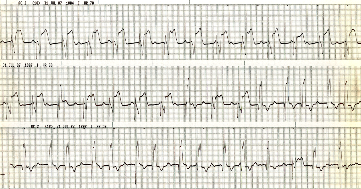 77 year old woman with gross hypoxia and mixed acidosis. What is the nature of the early beats? 