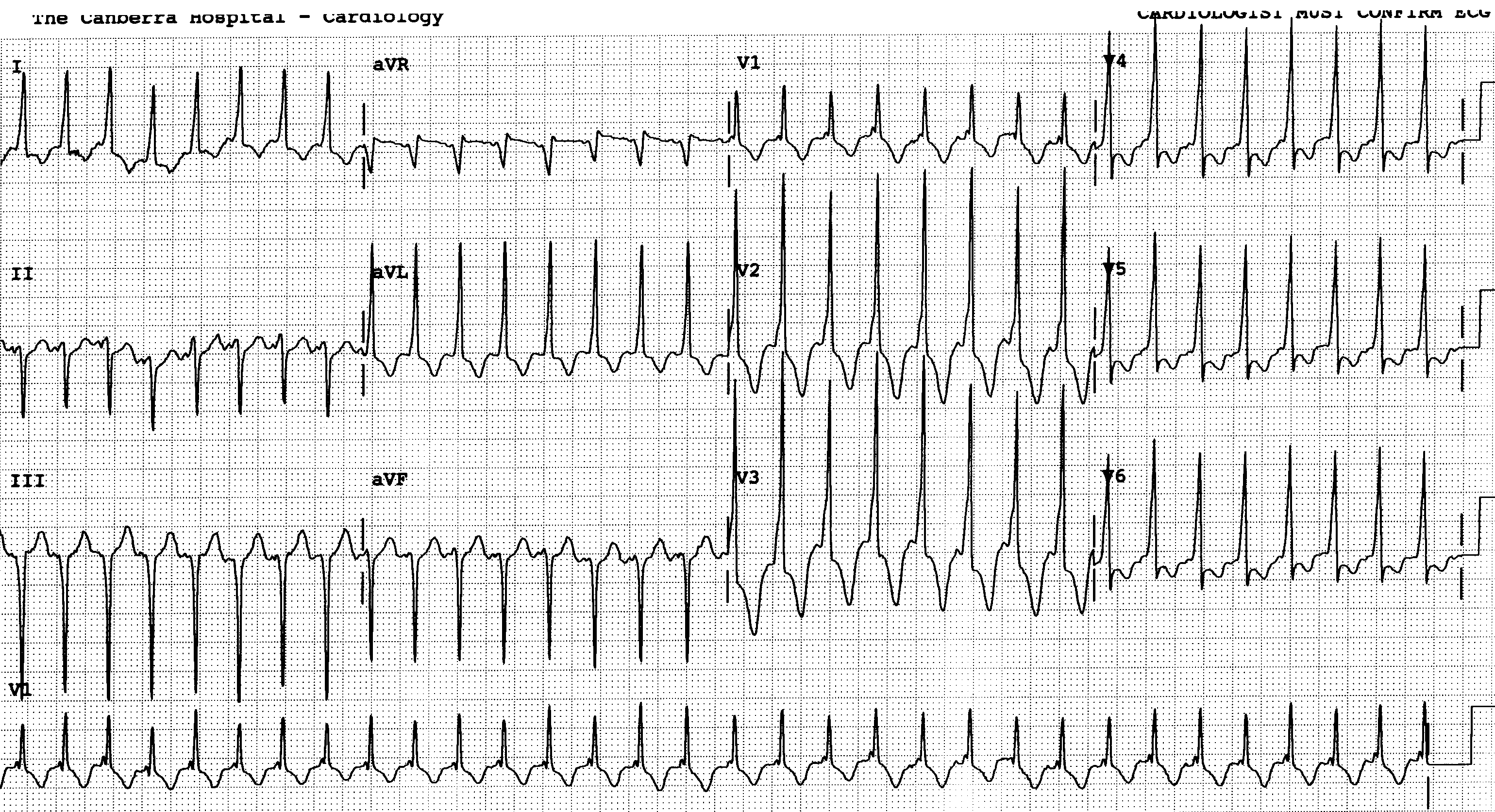 Seven week old girl with intermittent tachycardia and heart failure.