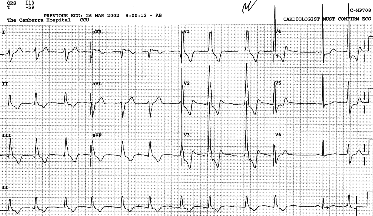 79 year old man with chest pain and bigeminy.