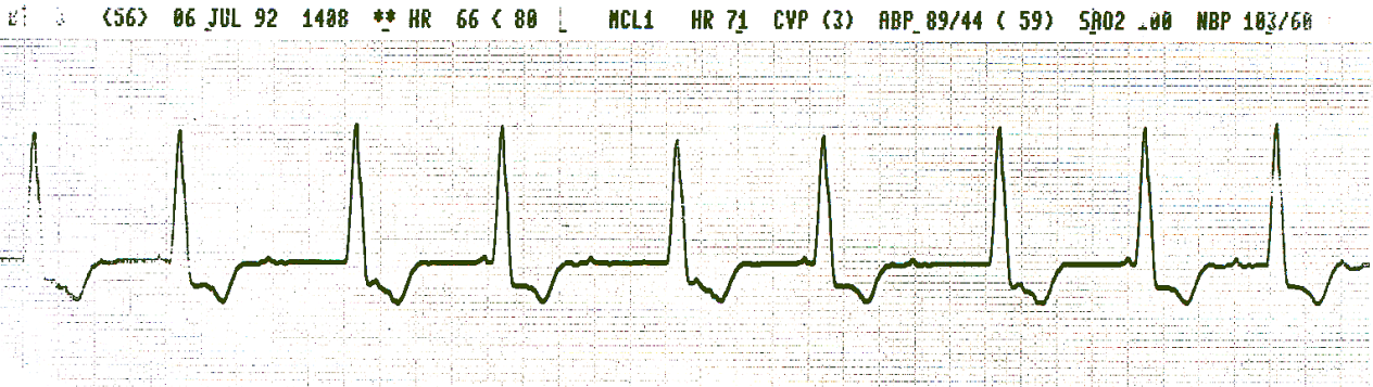 Blocked P     waves âskippedâ during 3:2 Wenckebach conduction with unusually long PR     intervals.