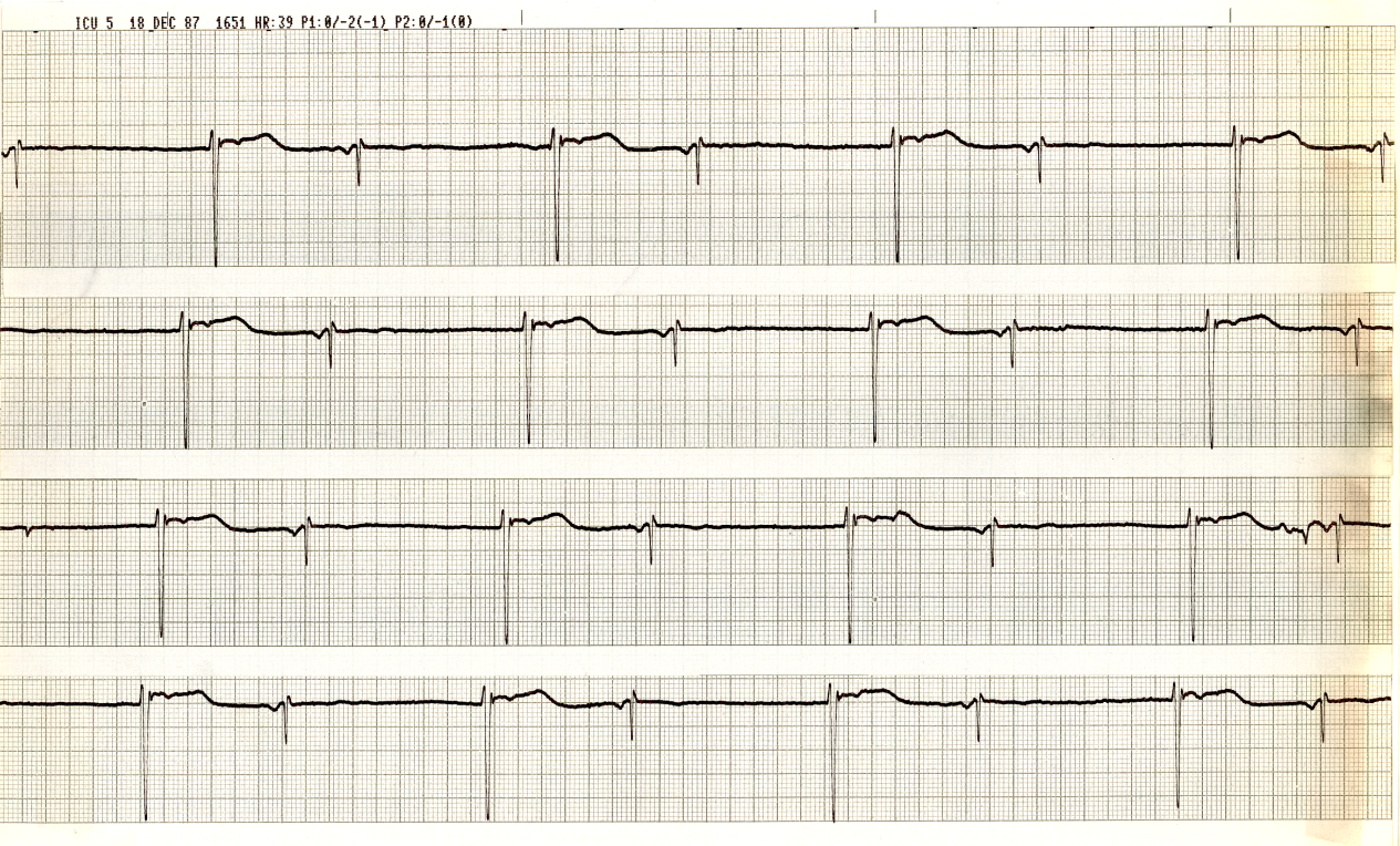 Sequential recordings over four days in a man admitted with acute myocardial infarction. What is the likely site of the infarction and why? What coronary artery is âinfarct-relatedâ in his case? What is the likely status of his left anterior descending (LAD) artery? 