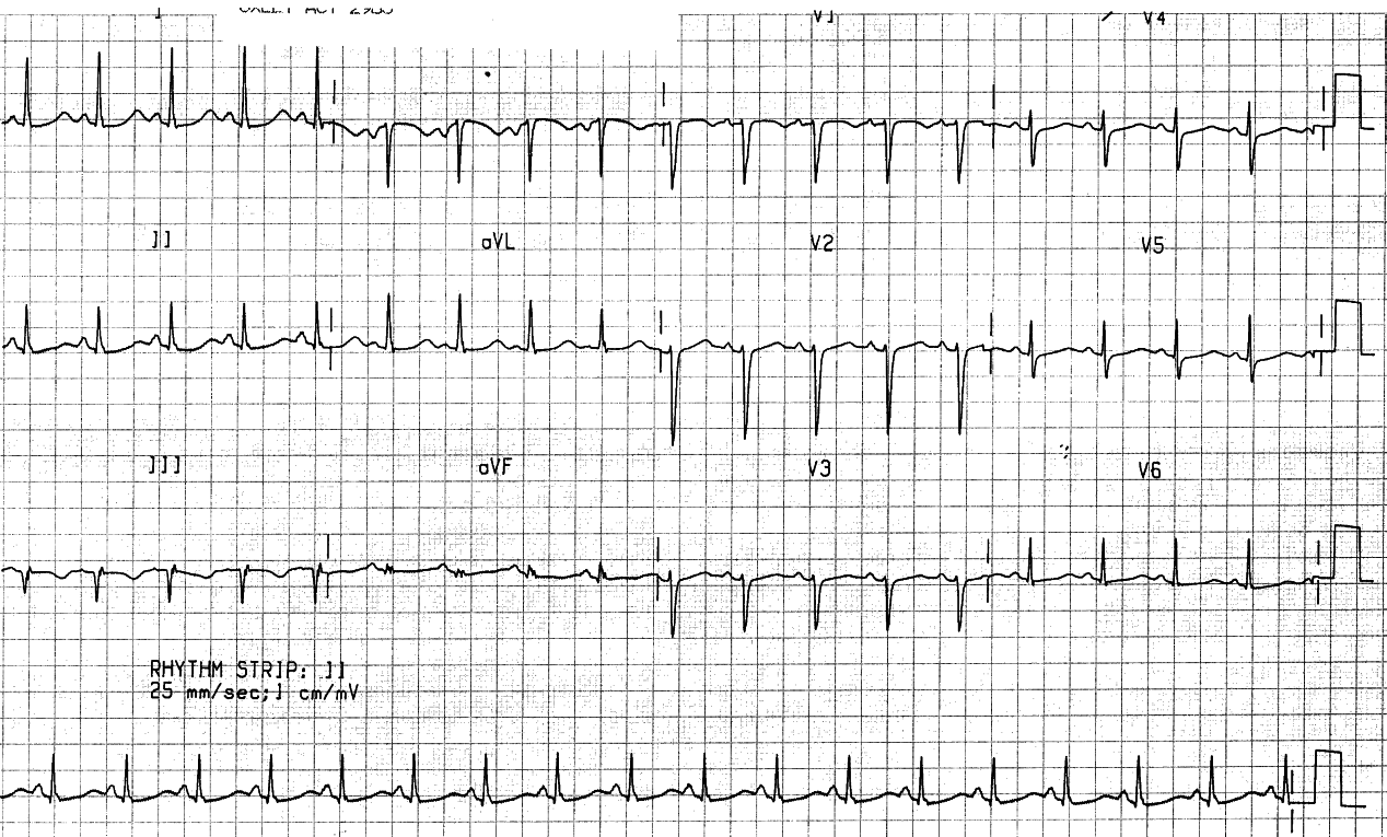 18 year old girl who walked into her GPâs surgery stating chest discomfort and family history of heart disease before collapsing in VF. Following defibrillation, all the routine investigations (echocardiogram, lung scan, ABGs, etc) were normal - except for the ECG shown below.