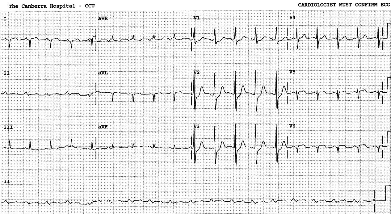 73 year old man with precordial tightness and heart failure.