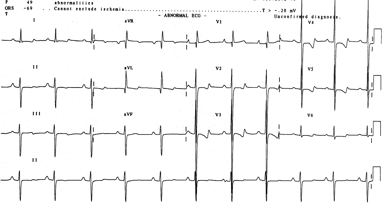 20 year old lady with Down syndrome, clubbed and cyanosed since infancy