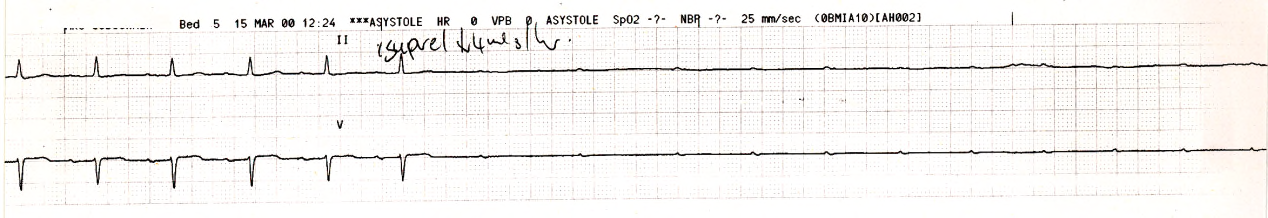 80 year old lady with aortic stenosis and     syncope. 