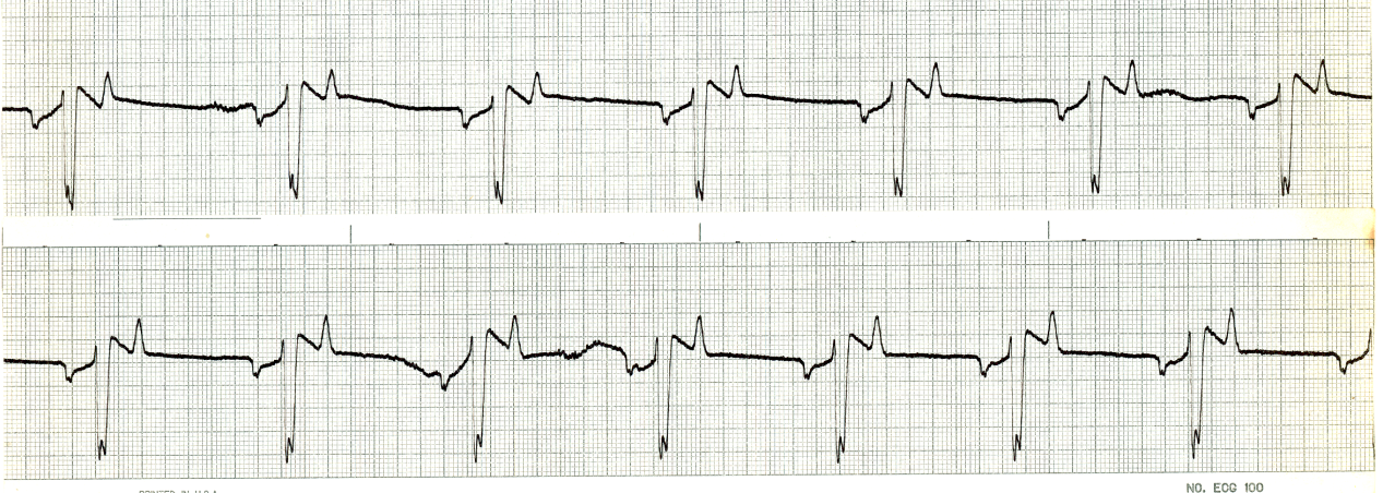 62 year old man dying in acute renal failure