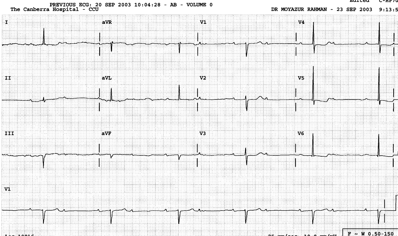 The ST/T configuration in V5-6 is a classical
âhockey stickâ appearance of digoxin effect (not toxicity). However, the
patient was not on digoxin.