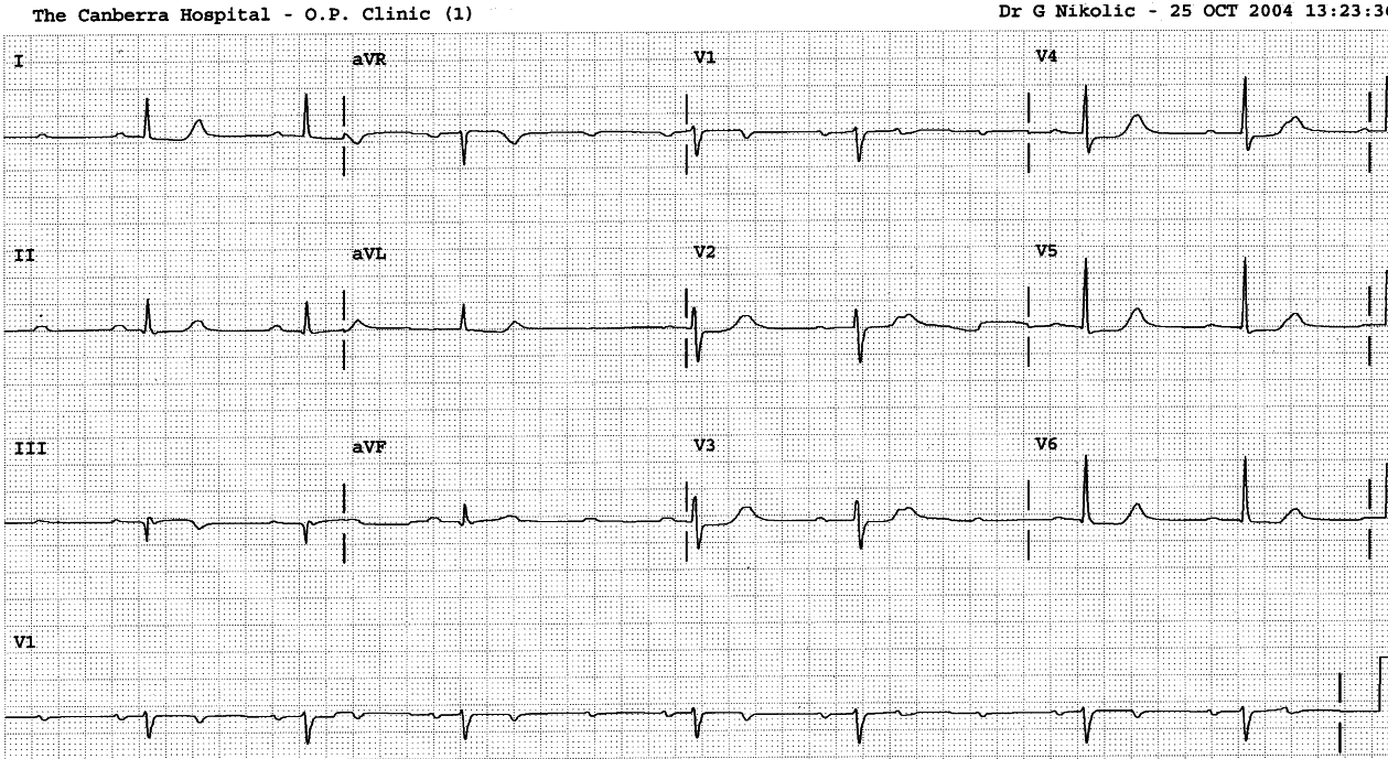 50 year old man with recurrent small infarctions due to triple vessel disease. 