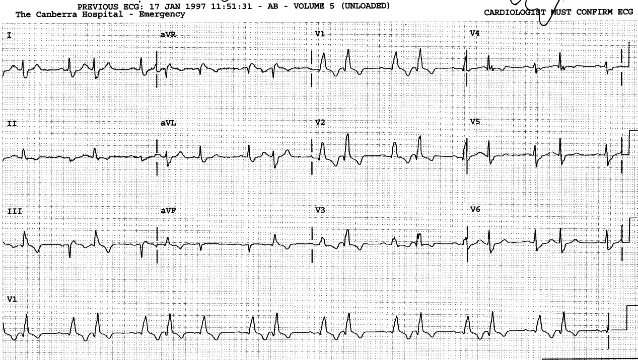 89 year old man with complex ECG but no cardiac history or symptoms.