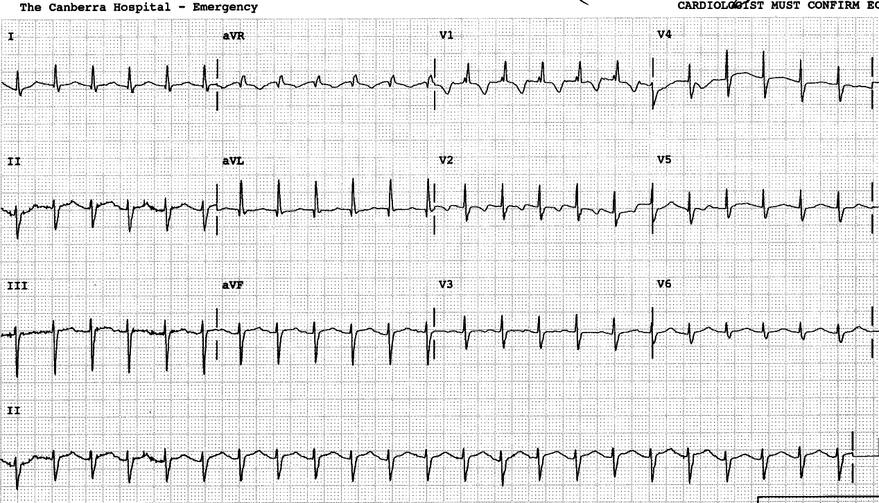 Three year old girl with large pericardial effusion following repair of an ASD