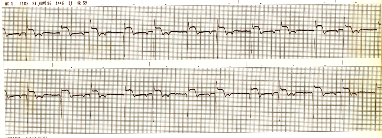 55 year old man on Day 3 of acute inferolateral     infarction. Half his QRS complexes look slightly different and a third     of his P waves appear to be missing. Why?  