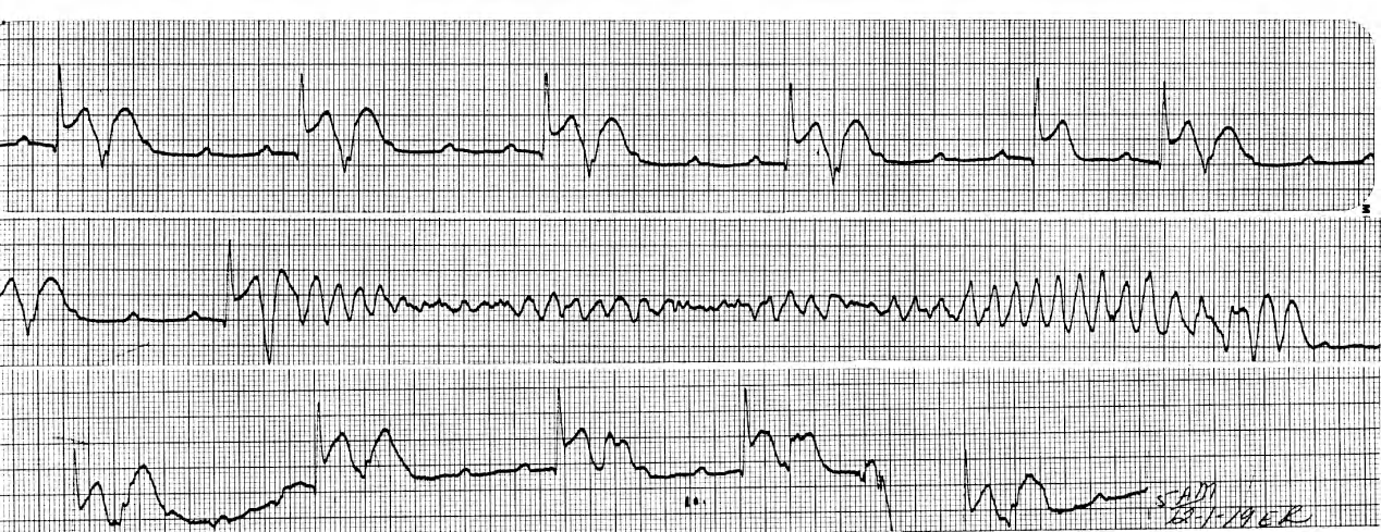 Acute inferior infarction in a 49 year old lady. 