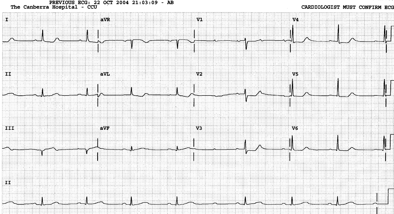 Persistent AV block. Almost half the P waves are âhidingâ in T waves.