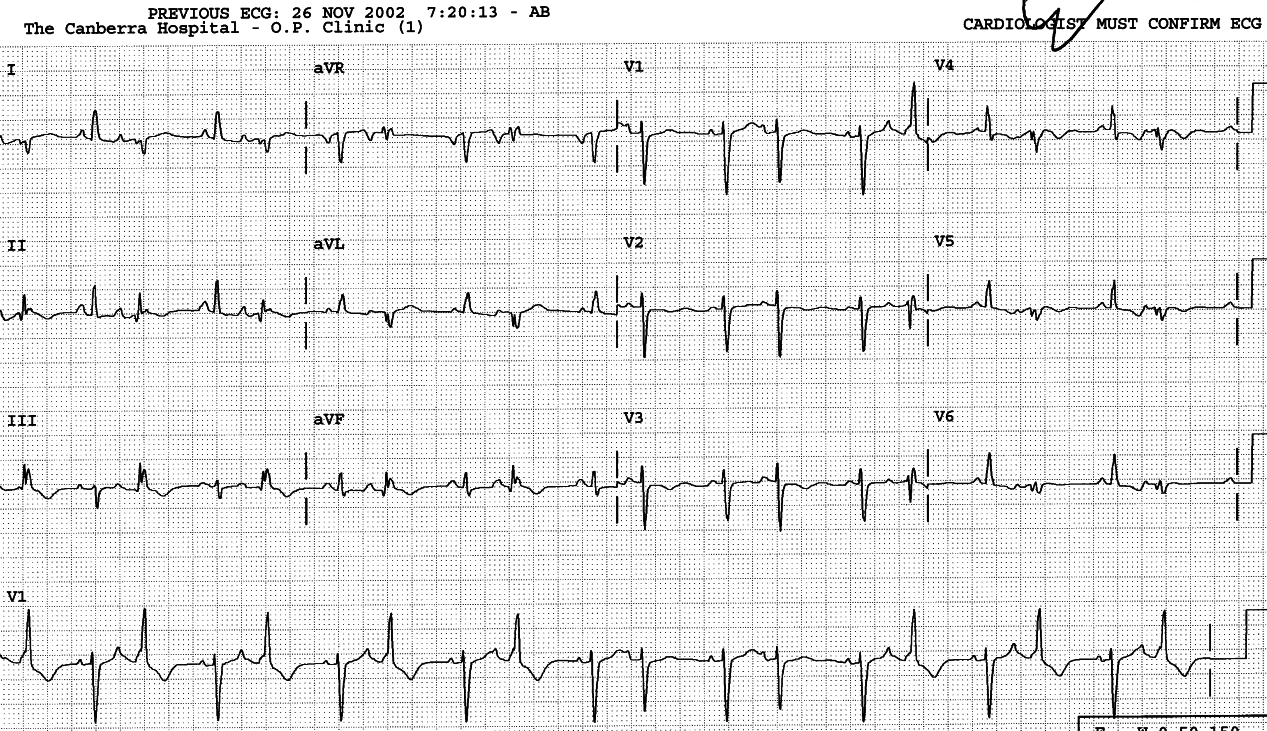 Another patient. The ST/T changes are abnormal in both the sinus and the aberrantly conducted premature beats.