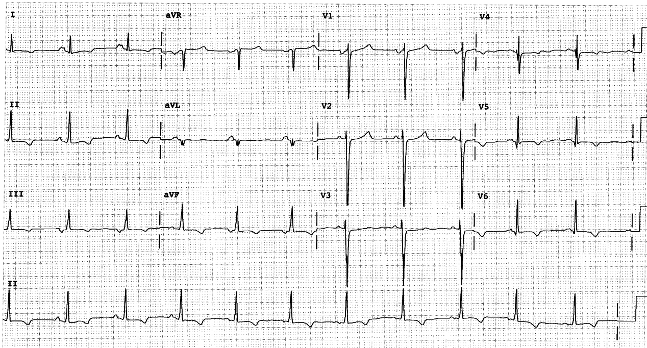 29 year old woman with chest pain and syncope, defibrillated in the Ambulance. Coronary angiogram showed normal arteries