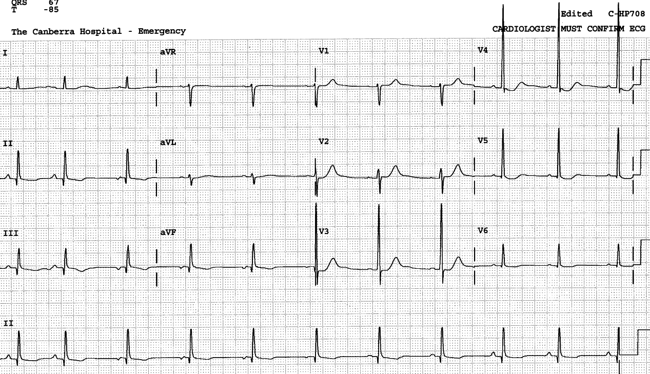 89 year old man in Casualty with urinary retention. There is no     cardiac history. 