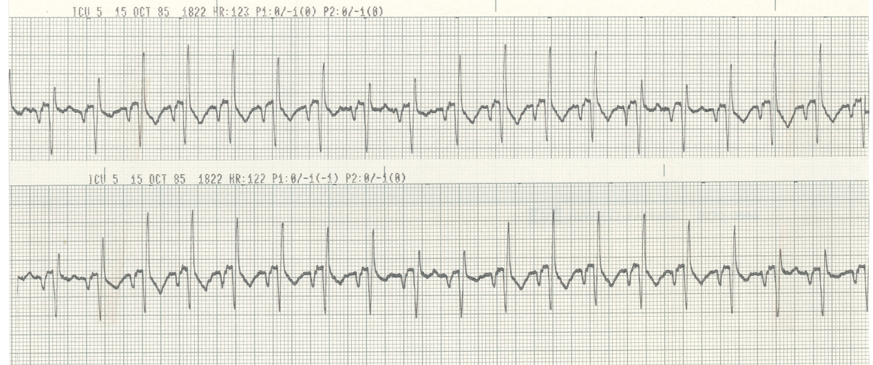 Routine postoperative monitoring in a lady with history of ischÃ¦mic disease