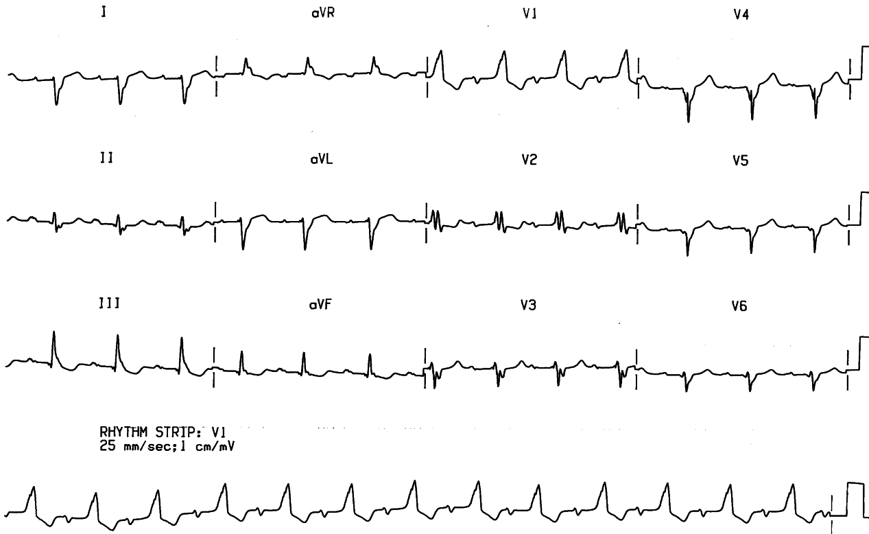 73 year old man with diabetes, cardiomegaly and peripheral vascular disease. He sustained an MI 12 years previously and is admitted for carotid endarterectomy.