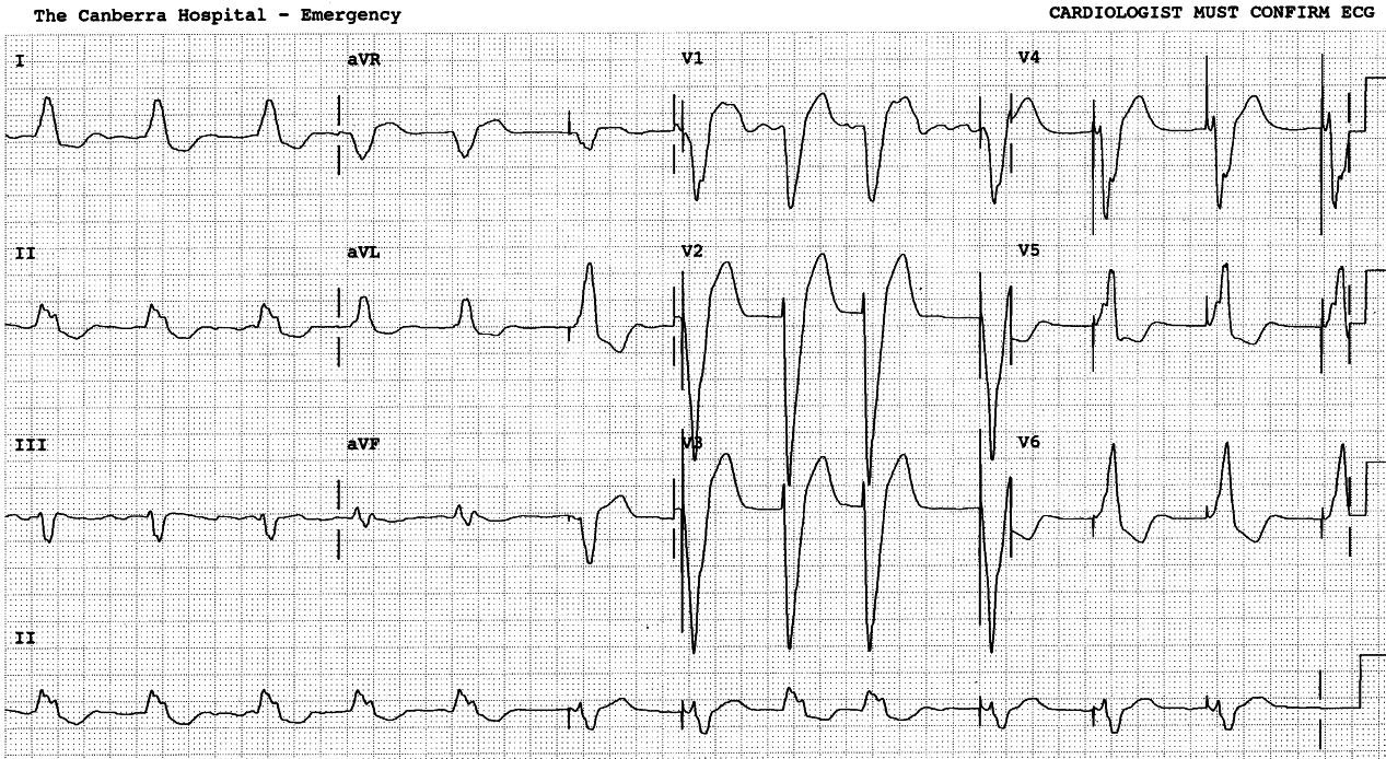 Lead 2 strip is useful here since the native LBBB has normal
frontal plane axis.