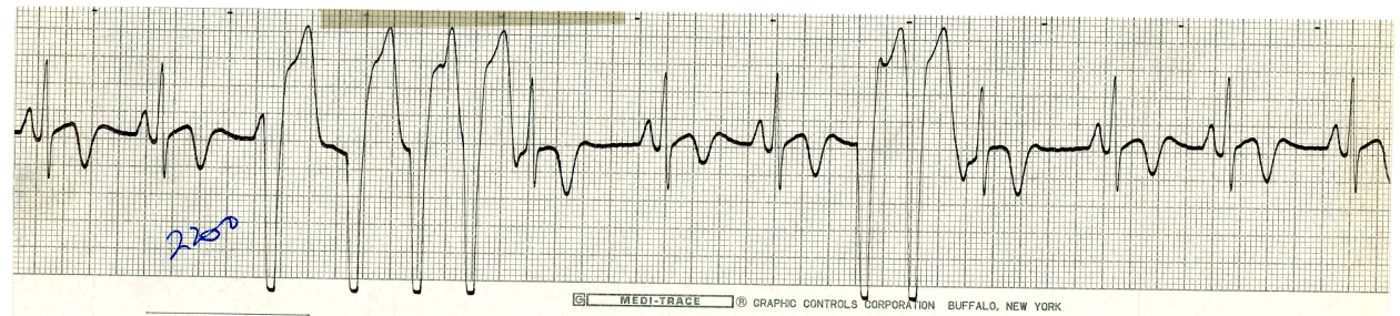 In the strip below, are there more QRS complexes of     ventricular or of supraventricular origin?  