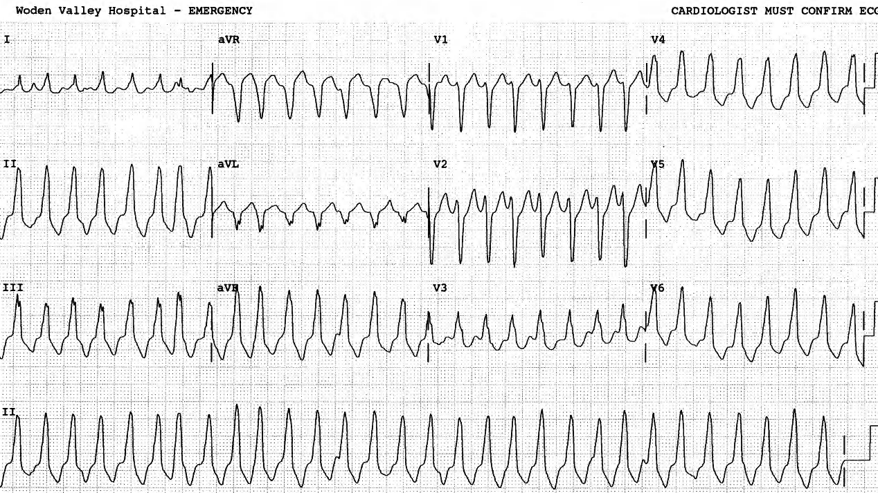 30 year old woman with normal heart and history of both VT and SVT. Ablation was performed following EPS for the SVT. 