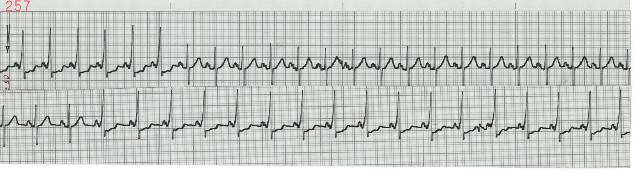 72 year old man receiving a 50 mg bolus of Xylocaine.