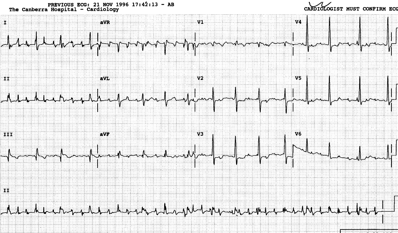 58 year old man with irregular pulse. Why is the pulse irregular?