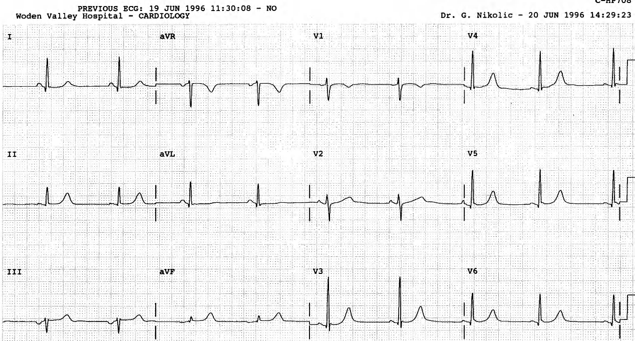 Normal trace. 