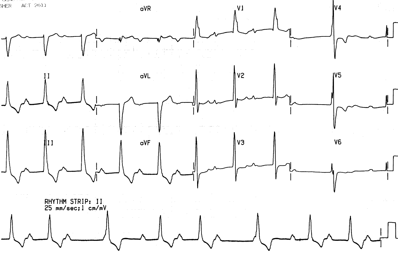 38 year old woman with Eisenmenger syndrome thought to be secondary to a variant of a single ventricle (cor triloculare biatrium, common ventricle)