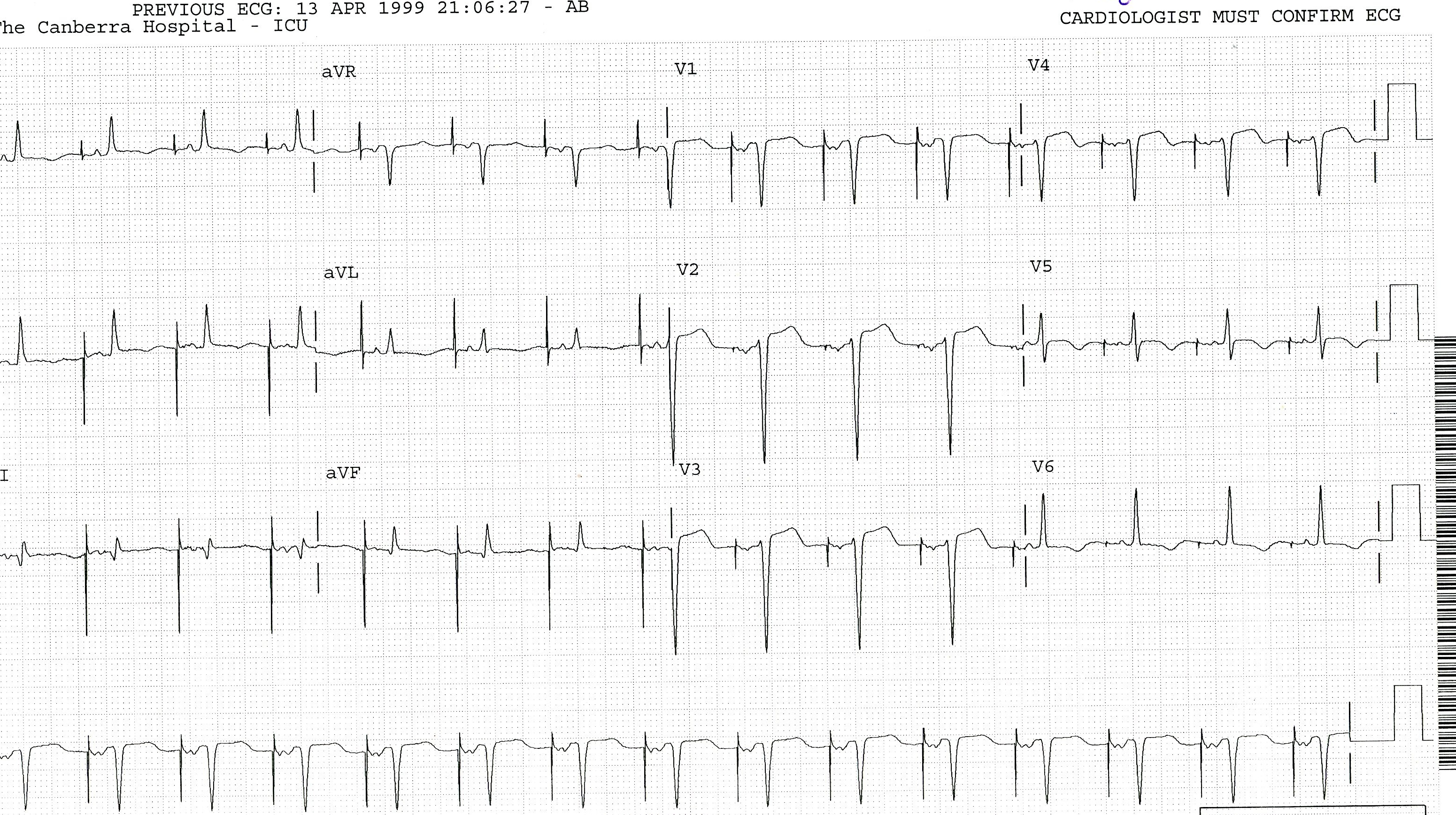 Faster atrial pacing immediately postoperatively, with 100%
capture. The LAA cannot be diagnosed with atrial pacing.
