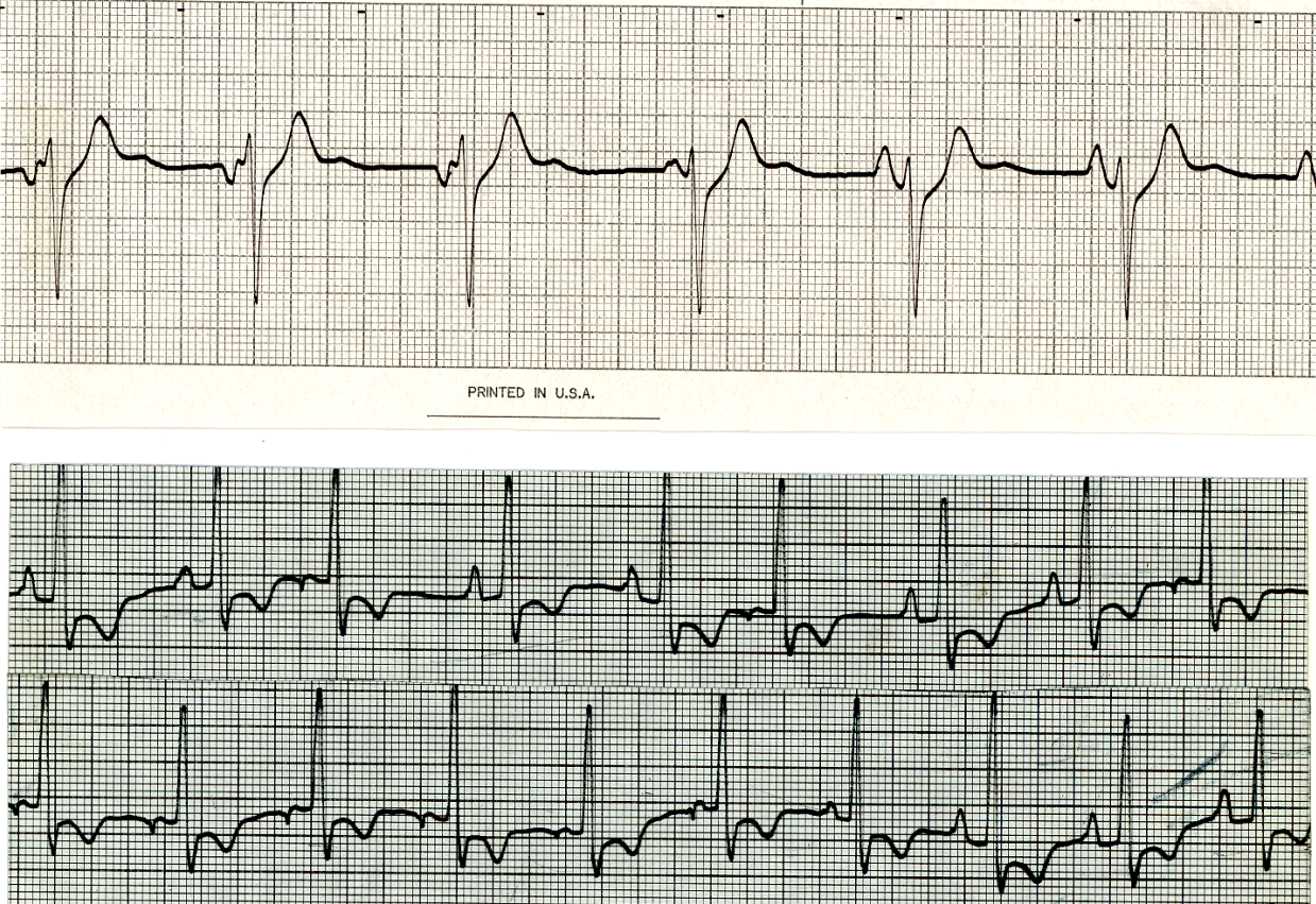 Atrial fusion beats from two different patients, 