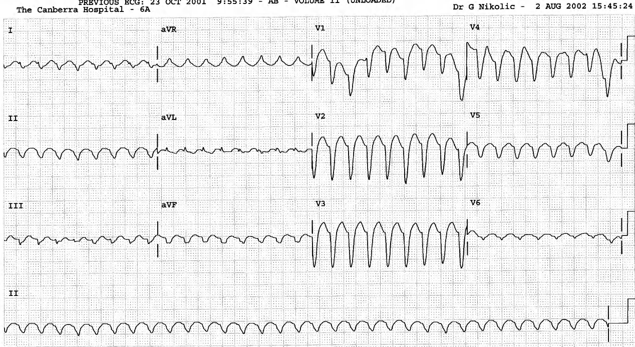 70 year old lady with history of asthma and congestive heart failure, during a paroxysm of recurrent tachycardia. 