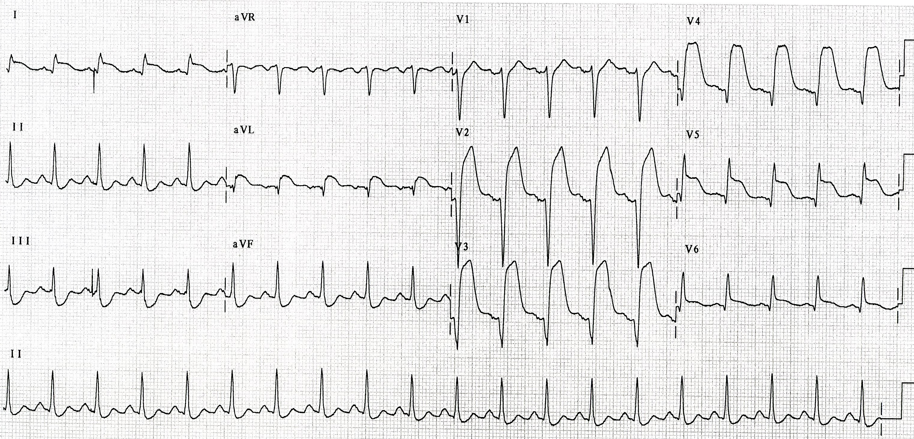 Same man 30 minutes later, about to be transferred to Catheter Lab. What are the likely findings?