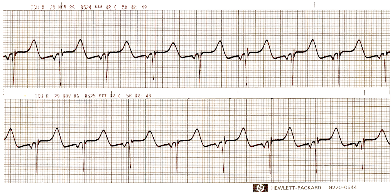 HÃ¦modynamically stable 35 year old woman, with normal blood gases and chemistries, in coma from CO poisoning. She is not on any cardiac medication. What is the likely explanation of the abnormality shown?