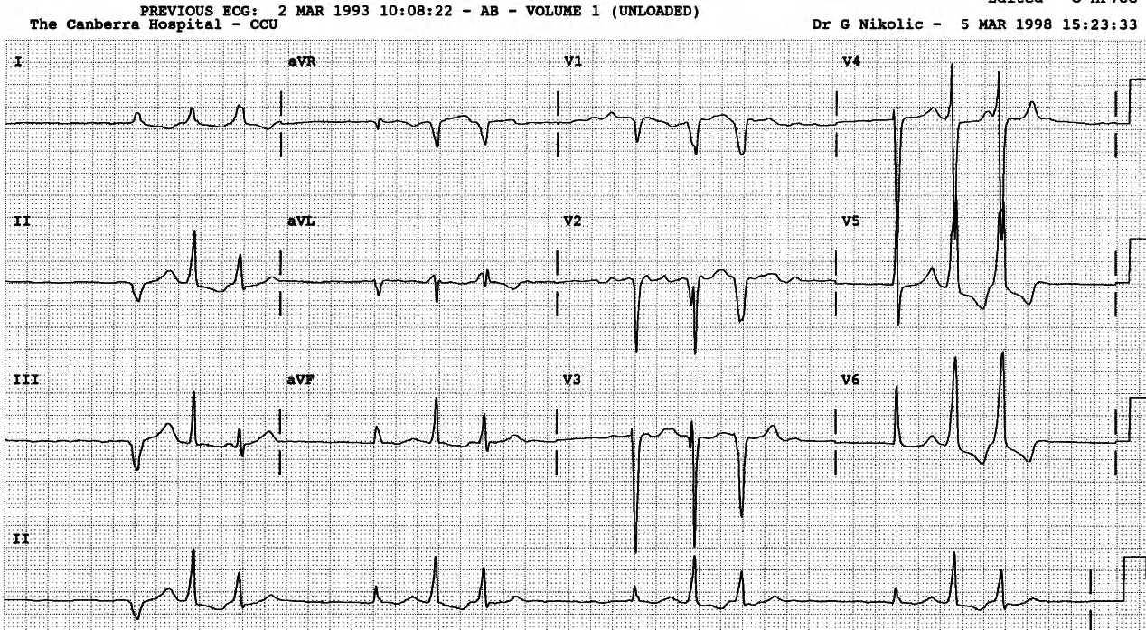 81 year old man with chronic AF, on regular digoxin therapy. 