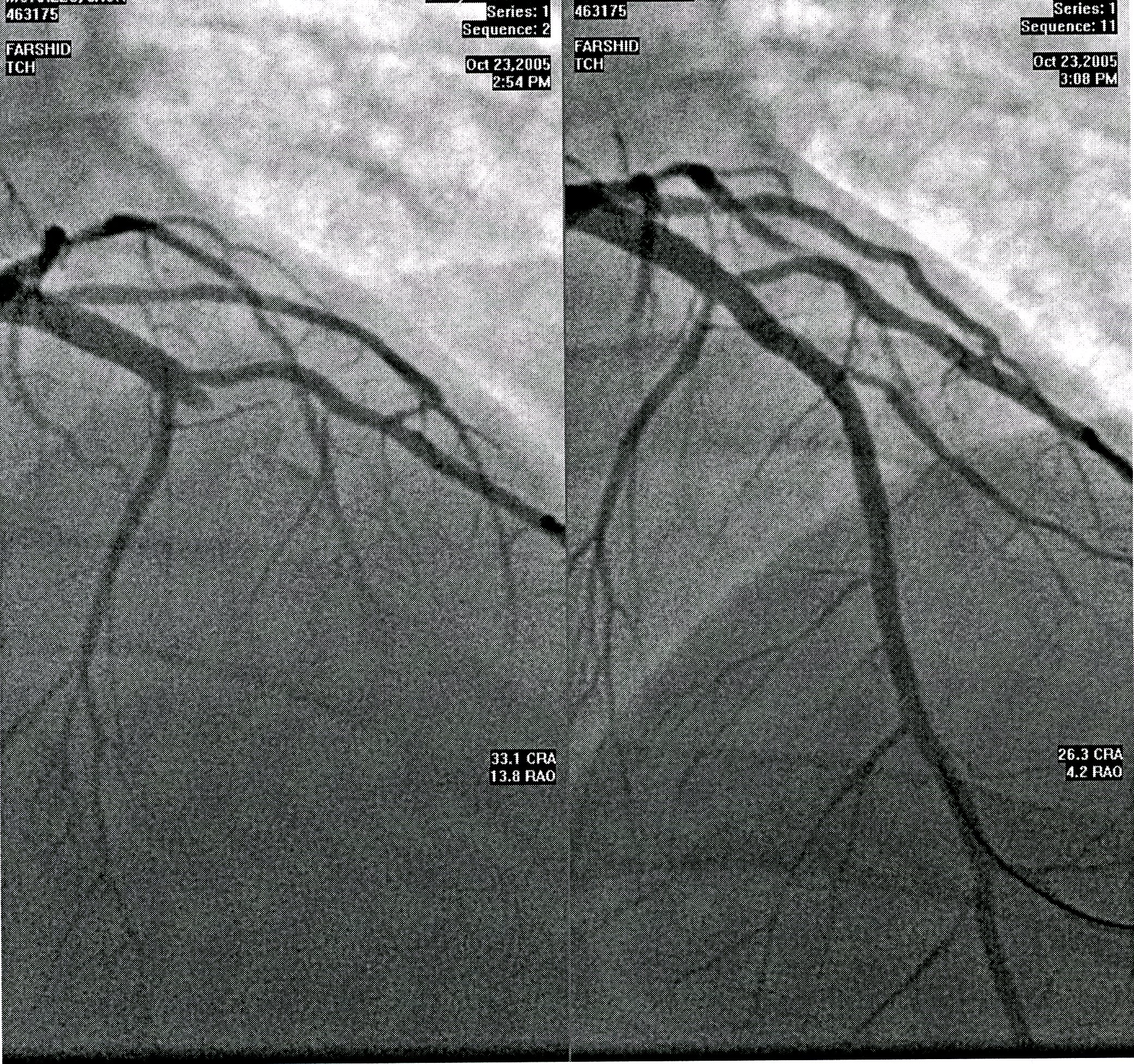 Angiograms before and after the LAD artery balloon angioplasty.