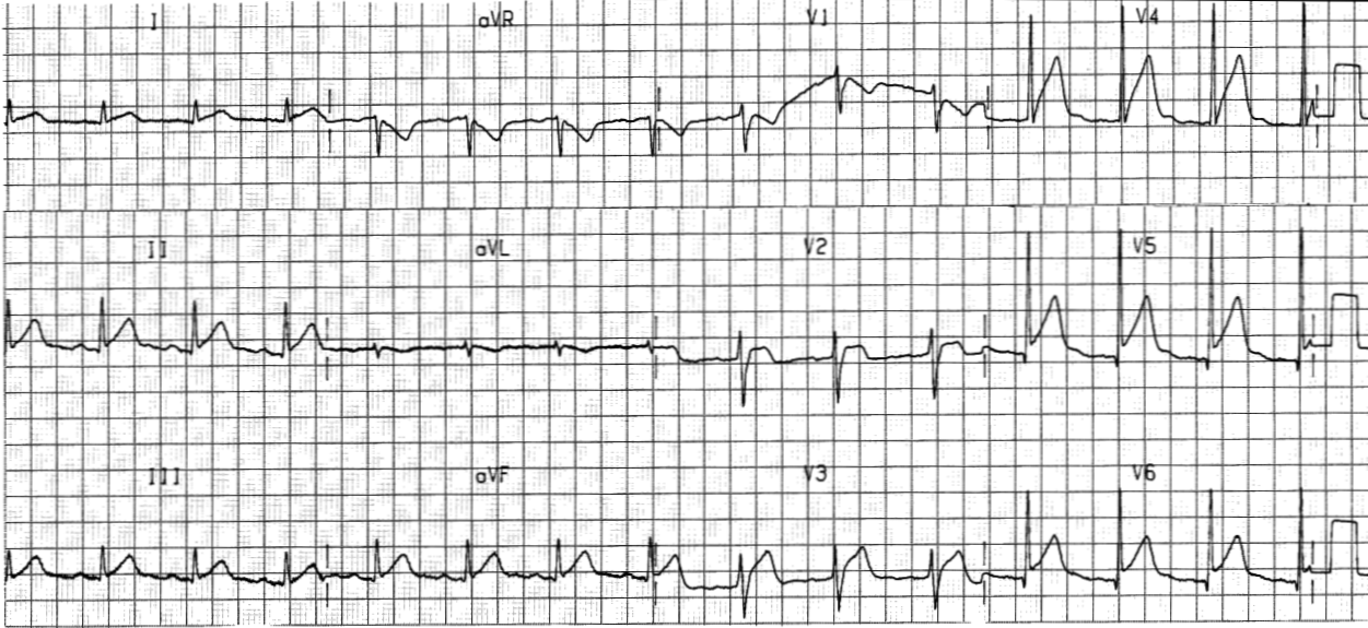 31 year old man recovering from aminophylline overdose