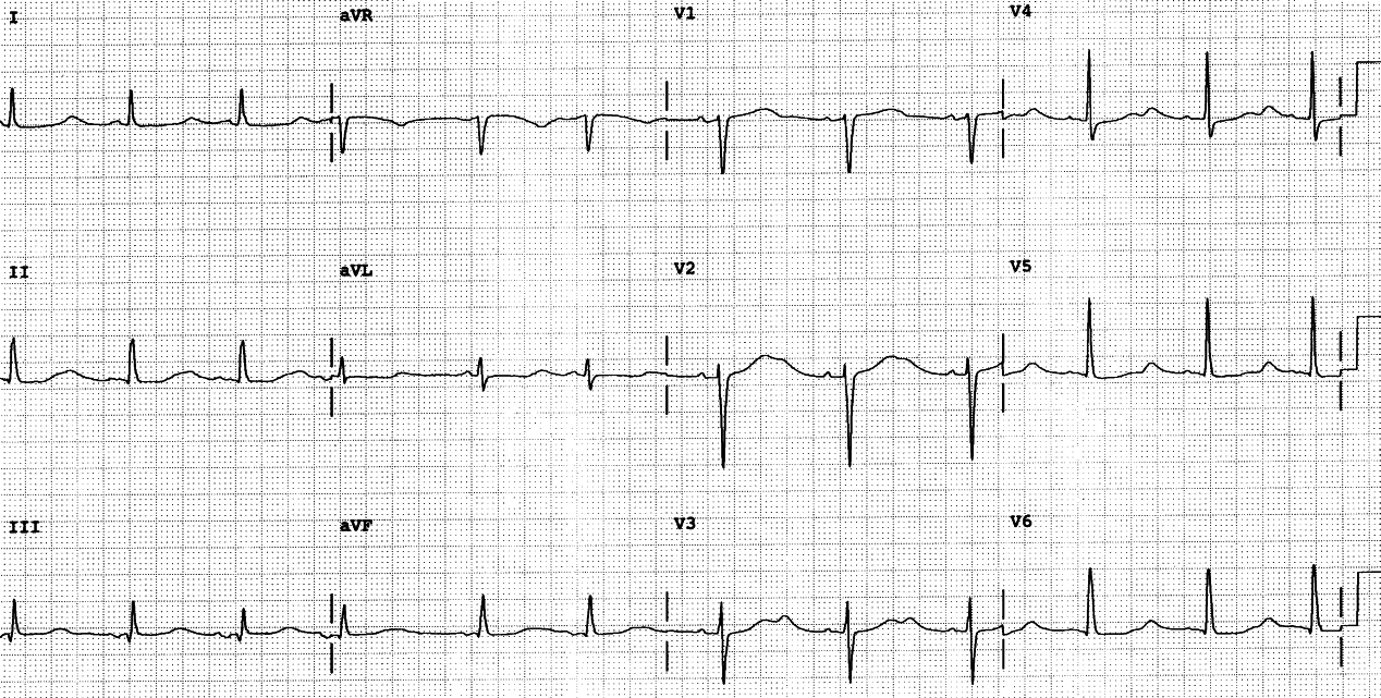 64 year old woman with unstable angina, on hÃ¦modialysis for chronic renal failure