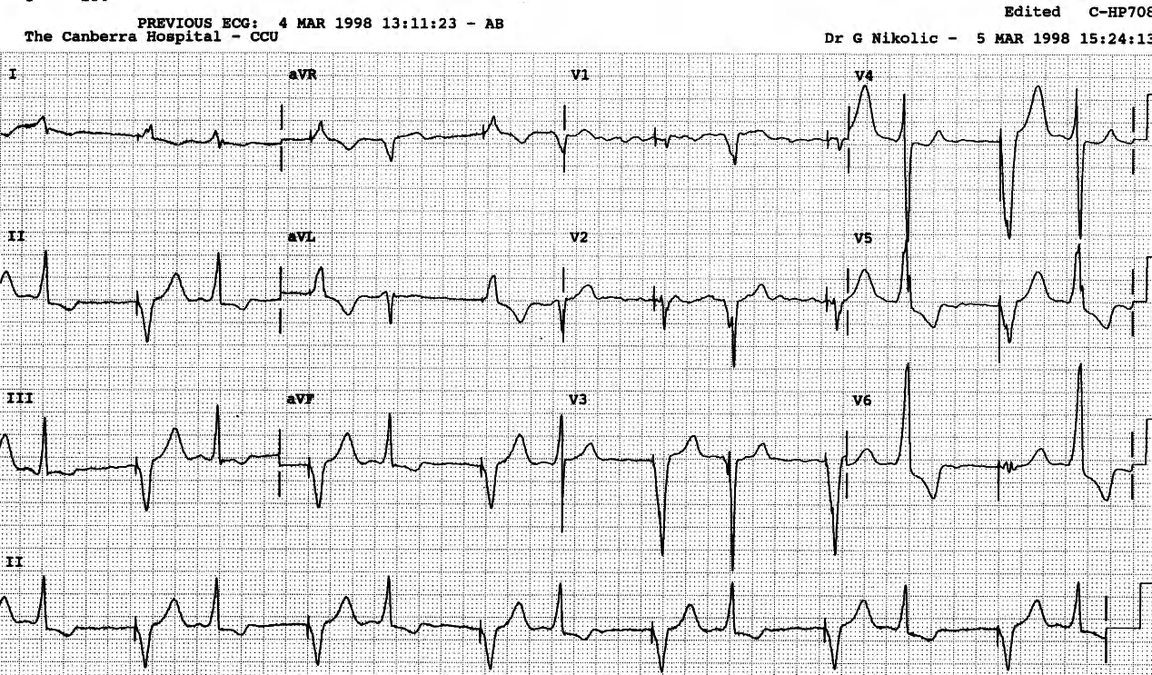 The VEBs resemble the tallest complexes in the previous trace. 