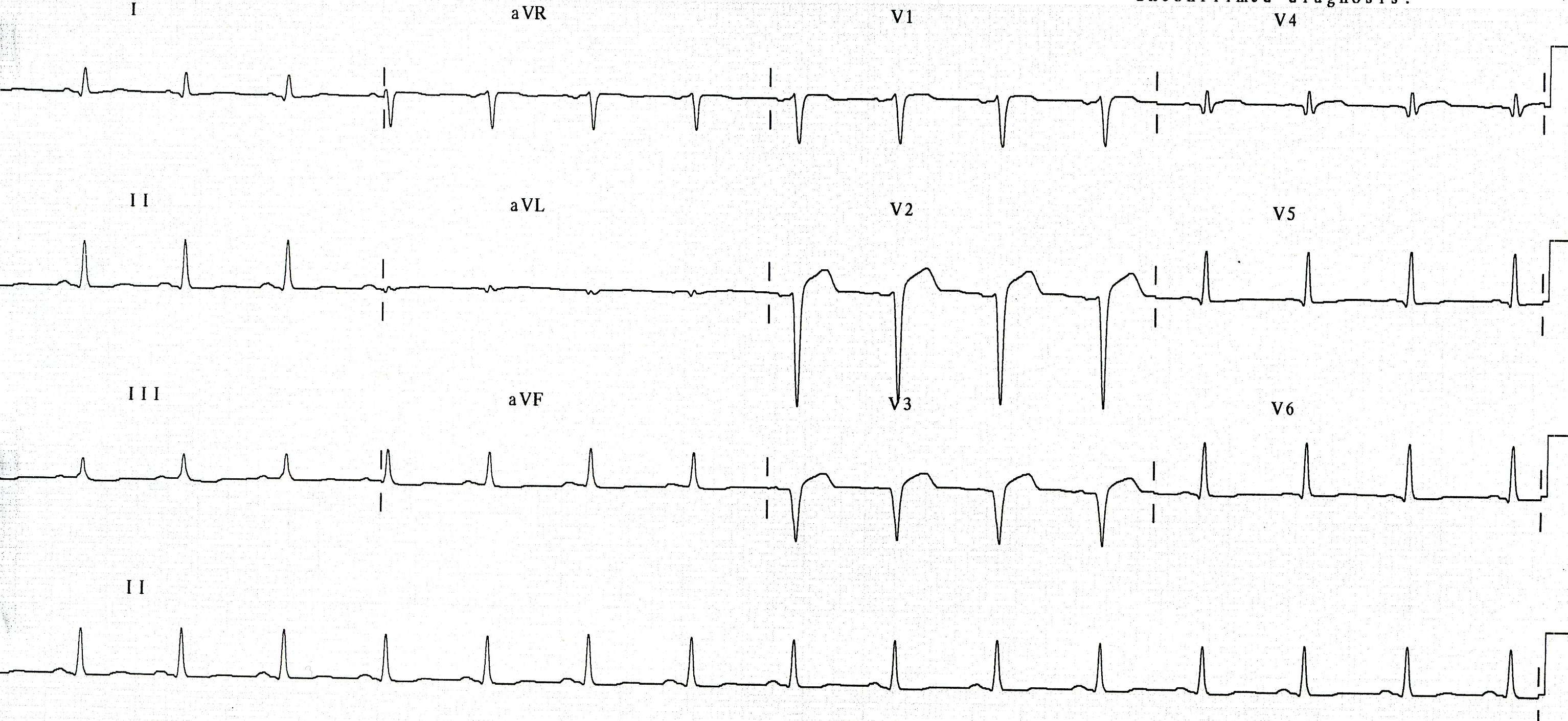 Evolving anterior MI. This is not as disappointing as it looks: the infarct size had been limited by the PCI and many of its later complications rendered less likely to occur.