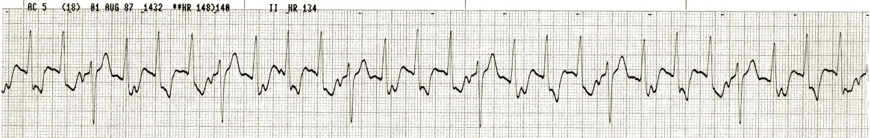 46 year old man with acute anterior infarction immediately after a streptokinase infusion. 