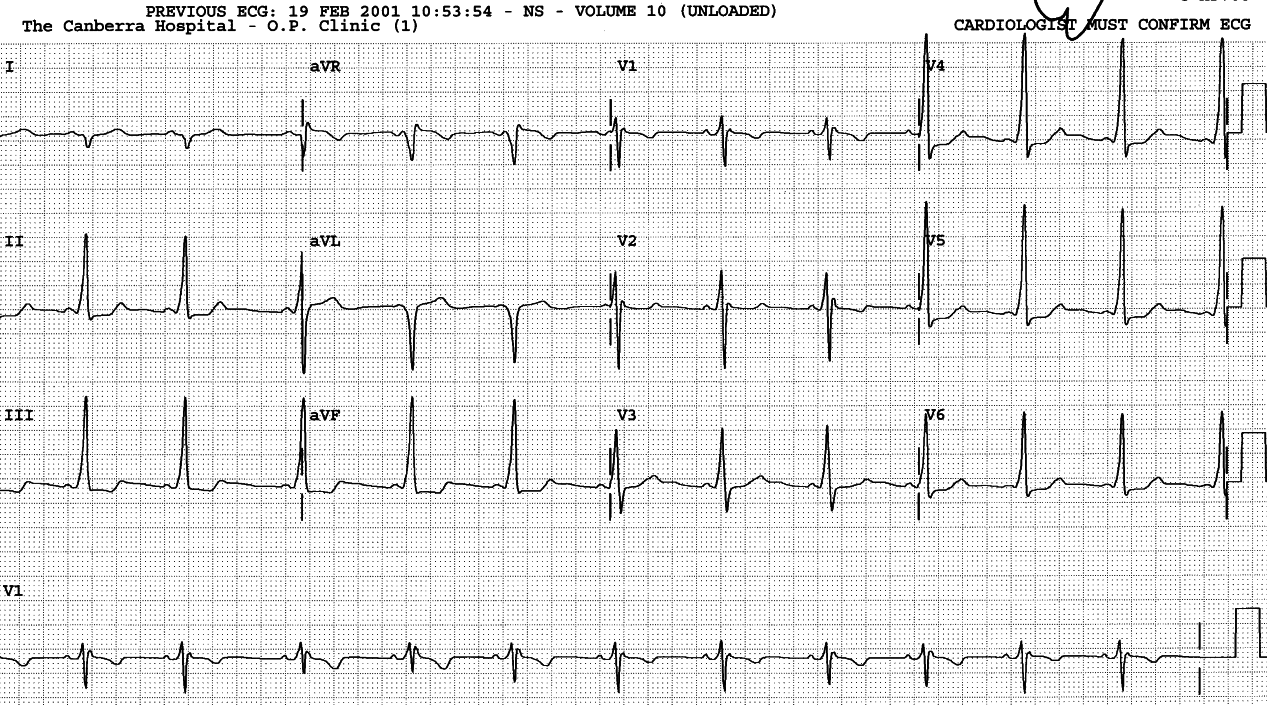 This is a type âBâ WPW conduction with RAD.